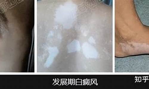 卤米松乳膏治白颠疯用多长时间合适_白癜风